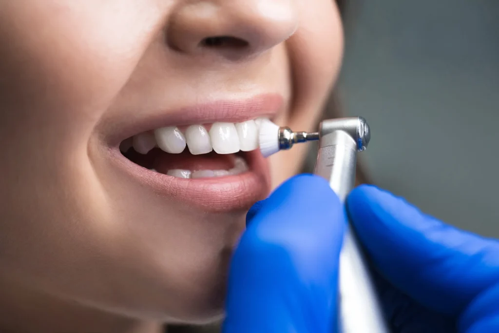 In-office professional teeth whitening session at Full Smile Dental Chicago Illinois