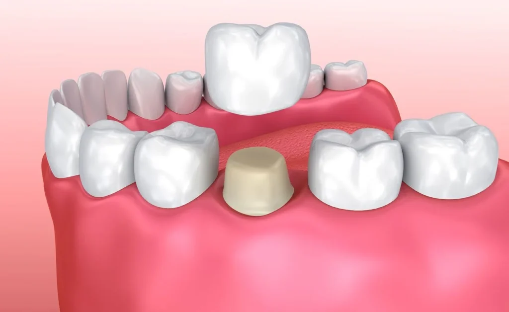 Dental crown placed after root canal treatment at Full Smile Dental Chicago Illinois