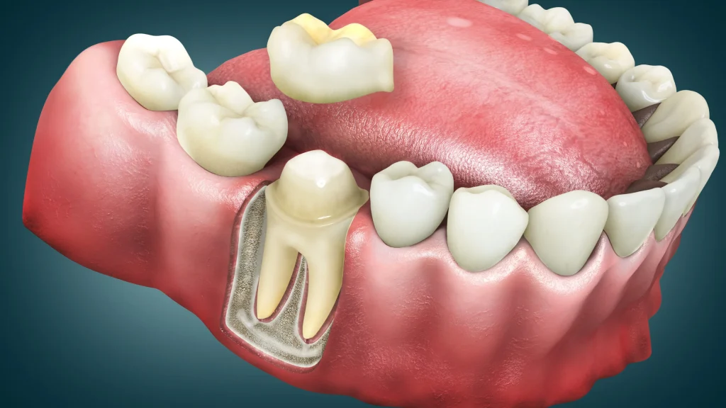 Traditional dental crown two-visit process at Full Smile Dental Chicago Worth Illinois